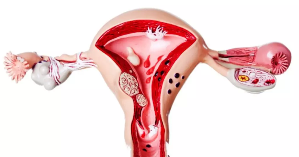Đi tiểu thường xuyên - Dấu hiệu cảnh báo lạc nội mạc tử cung khiến nhiều người bất ngờ